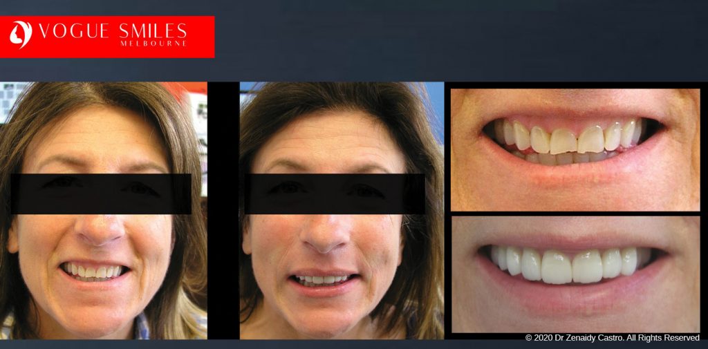 Porcelain Veneers Before and After Melbourne - Veneer Cost Melbourne From $700 per tooth *- Dental Veneers Smile Gallery - VOGUE SMILES COSMETIC DENTAL