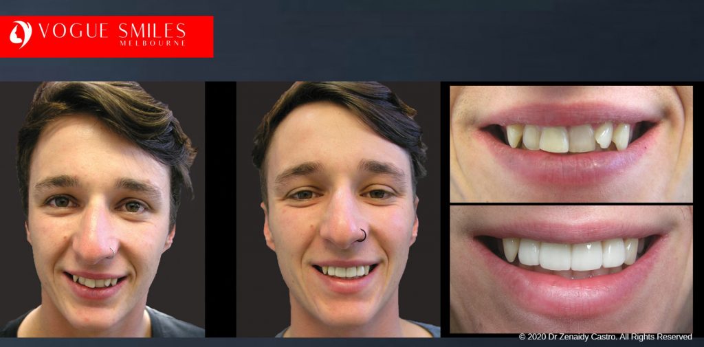 Porcelain Veneers Before and After Melbourne - Veneer Cost Melbourne From $700 per tooth *- Dental Veneers Smile Gallery - VOGUE SMILES COSMETIC DENTAL