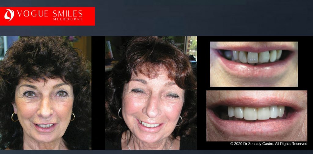 Porcelain Veneers Before and After Melbourne - Veneer Cost Melbourne From $700 per tooth *- Dental Veneers Smile Gallery - VOGUE SMILES COSMETIC DENTAL