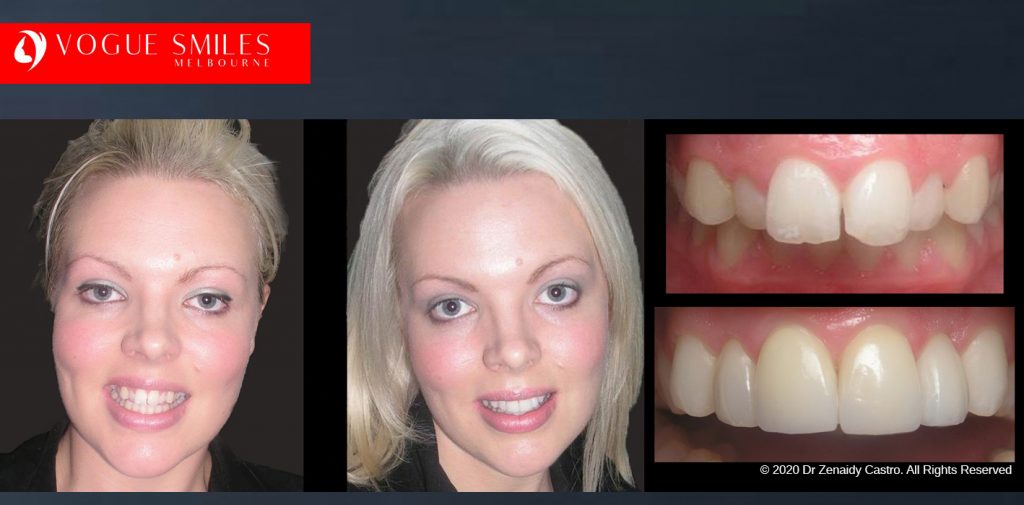 Porcelain Veneers Before and After Melbourne - Veneer Cost Melbourne From $700 per tooth *- Dental Veneers Smile Gallery - VOGUE SMILES COSMETIC DENTAL