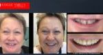 Anti-Aging Dentistry Before & After | Dental Facelift Photos -Facelift Before and After- Leading Cosmetic Dentist in Melbourne Australia