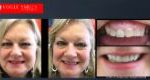 Anti-Aging Dentistry Before & After | Dental Facelift Photos -Facelift Before and After- Leading Cosmetic Dentist in Melbourne Australia