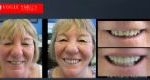 Anti-Aging Dentistry Before & After | Dental Facelift Photos -Facelift Before and After- Leading Cosmetic Dentist in Melbourne Australia