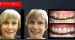 Anti-Aging Dentistry Before & After | Dental Facelift Photos -Facelift Before and After- Leading Cosmetic Dentist in Melbourne Australia