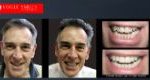 Anti-Aging Dentistry Before & After | Dental Facelift Photos -Facelift Before and After- Leading Cosmetic Dentist in Melbourne Australia