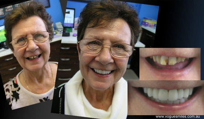 Smile Makeover Melbourne Cbd General And Cosmetic Dentistry Vogue Smiles Melbourne