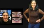 Cosmetic Dentistry Smile Makeovers Before and After Smile Gallery | Australia's Top Cosmetic Dentist