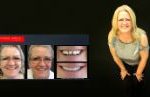 Cosmetic Dentistry Smile Makeovers Before and After Smile Gallery | Australia's Top Cosmetic Dentist