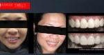 Dental Bonding Before and After | Composite Veneers Smile Gallery Melbourne CBD