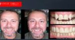 Dental Bonding Before and After | Composite Veneers Smile Gallery Melbourne CBD