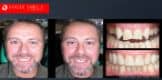 Dental Bonding Before and After | Composite Veneers Smile Gallery Melbourne CBD