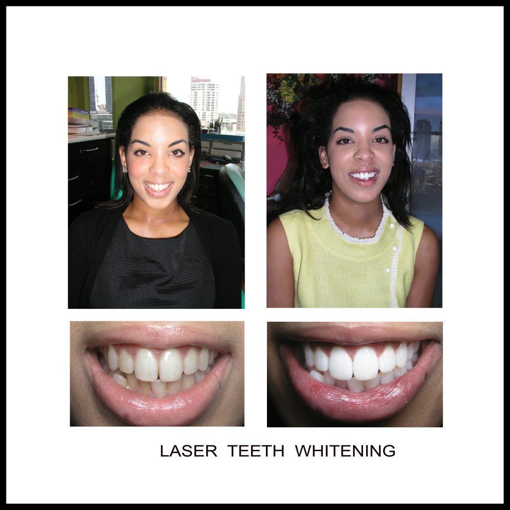 How much does teeth whitening cost melbourne