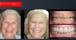 Short Teeth before and after photos, Small Teeth before and after photos, Worn-down Teeth before and after photos