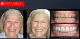 Short Teeth before and after photos, Small Teeth before and after photos, Worn-down Teeth before and after photos