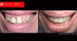 Full Mouth Reconstruction & Rehabilitation BEFORE AND AFTER, Close-up dental Photos Before and After, Affordable Cosmetic Dentist NEAR ME Melbourne Before and After, Improve Smiles Before and After