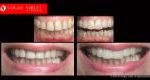 Full Mouth Reconstruction & Rehabilitation BEFORE AND AFTER, Close-up dental Photos Before and After, Affordable Cosmetic Dentist NEAR ME Melbourne Before and After, Improve Smiles Before and After