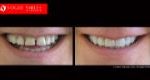 Full Mouth Reconstruction & Rehabilitation BEFORE AND AFTER, Close-up dental Photos Before and After, Affordable Cosmetic Dentist NEAR ME Melbourne Before and After, Improve Smiles Before and After