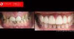 Extreme Smile Makeover Before and After Melbourne, Full Mouth Reconstruction- Full Dental Reconstruction - Mouth Rehabilitation & Implants Before and After Melbourne, close-up smile photo before and after Melbourne