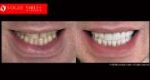 Extreme Smile Makeover Before and After Melbourne, Full Mouth Reconstruction- Full Dental Reconstruction - Mouth Rehabilitation & Implants Before and After Melbourne, close-up smile photo before and after Melbourne