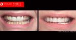 Extreme Smile Makeover Before and After Melbourne, Full Mouth Reconstruction- Full Dental Reconstruction - Mouth Rehabilitation & Implants Before and After Melbourne, close-up smile photo before and after Melbourne