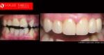 Extreme Smile Makeover Before and After Melbourne, Full Mouth Reconstruction- Full Dental Reconstruction - Mouth Rehabilitation & Implants Before and After Melbourne, close-up smile photo before and after Melbourne