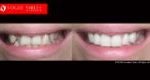 Extreme Smile Makeover Before and After Melbourne, Full Mouth Reconstruction- Full Dental Reconstruction - Mouth Rehabilitation & Implants Before and After Melbourne, close-up smile photo before and after Melbourne