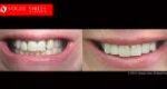 Cosmetic Dentistry Treatment Results Gallery, closeup photos porcelain veneers before and after Melbourne, Affordable Dental Veneers Before and After Melbourne close-up, Vogue Smiles Dental Dentistry Melbourne Studios Clinic Practice