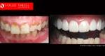 Cosmetic Dentistry Treatment Results Gallery, closeup photos porcelain veneers before and after Melbourne, Affordable Dental Veneers Before and After Melbourne close-up, Vogue Smiles Dental Dentistry Melbourne Studios Clinic Practice