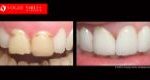 Cosmetic Dentistry Treatment Results Gallery, closeup photos porcelain veneers before and after Melbourne, Affordable Dental Veneers Before and After Melbourne close-up, Vogue Smiles Dental Dentistry Melbourne Studios Clinic Practice