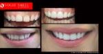 Cosmetic Dentistry Treatment Results Gallery, closeup photos porcelain veneers before and after Melbourne, Affordable Dental Veneers Before and After Melbourne close-up, Vogue Smiles Dental Dentistry Melbourne Studios Clinic Practice