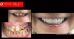 Cosmetic Dentistry Treatment Results Gallery, closeup photos porcelain veneers before and after Melbourne, Affordable Dental Veneers Before and After Melbourne close-up, Vogue Smiles Dental Dentistry Melbourne Studios Clinic Practice