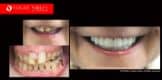 Cosmetic Dentistry Treatment Results Gallery, closeup photos porcelain veneers before and after Melbourne, Affordable Dental Veneers Before and After Melbourne close-up, Vogue Smiles Dental Dentistry Melbourne Studios Clinic Practice