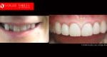 Cosmetic Dentistry Treatment Results Gallery, closeup photos porcelain veneers before and after Melbourne, Affordable Dental Veneers Before and After Melbourne close-up, Vogue Smiles Dental Dentistry Melbourne Studios Clinic Practice