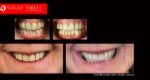 Cosmetic Dentistry Treatment Results Gallery, closeup photos porcelain veneers before and after Melbourne, Affordable Dental Veneers Before and After Melbourne close-up, Vogue Smiles Dental Dentistry Melbourne Studios Clinic Practice