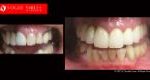 Cosmetic Dentistry Treatment Results Gallery, closeup photos porcelain veneers before and after Melbourne, Affordable Dental Veneers Before and After Melbourne close-up, Vogue Smiles Dental Dentistry Melbourne Studios Clinic Practice