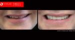 Full Mouth Reconstruction & Rehabilitation BEFORE AND AFTER, Close-up dental Photos Before and After, Affordable Cosmetic Dentist NEAR ME Melbourne Before and After, Improve Smiles Before and After