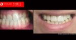 Cosmetic Dentistry Treatment Results Gallery, closeup photos porcelain veneers before and after Melbourne, Affordable Dental Veneers Before and After Melbourne close-up, Vogue Smiles Dental Dentistry Melbourne Studios Clinic Practice