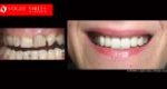 Cosmetic Dentistry Treatment Results Gallery, closeup photos porcelain veneers before and after Melbourne, Affordable Dental Veneers Before and After Melbourne close-up, Vogue Smiles Dental Dentistry Melbourne Studios Clinic Practice