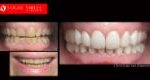 Cosmetic Dentistry Treatment Results Gallery, closeup photos porcelain veneers before and after Melbourne, Affordable Dental Veneers Before and After Melbourne close-up, Vogue Smiles Dental Dentistry Melbourne Studios Clinic Practice