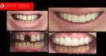 Cosmetic Dentistry Treatment Results Gallery, closeup photos porcelain veneers before and after Melbourne, Affordable Dental Veneers Before and After Melbourne close-up, Vogue Smiles Dental Dentistry Melbourne Studios Clinic Practice