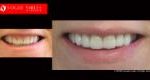 Cosmetic Dentistry Treatment Results Gallery, closeup photos porcelain veneers before and after Melbourne, Affordable Dental Veneers Before and After Melbourne close-up, Vogue Smiles Dental Dentistry Melbourne Studios Clinic Practice