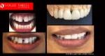 Cosmetic Dentistry Treatment Results Gallery, closeup photos porcelain veneers before and after Melbourne, Affordable Dental Veneers Before and After Melbourne close-up, Vogue Smiles Dental Dentistry Melbourne Studios Clinic Practice