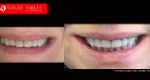 Cosmetic Dentistry Treatment Results Gallery, closeup photos porcelain veneers before and after Melbourne, Affordable Dental Veneers Before and After Melbourne close-up, Vogue Smiles Dental Dentistry Melbourne Studios Clinic Practice