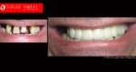 Full Mouth Reconstruction & Rehabilitation BEFORE AND AFTER, Close-up dental Photos Before and After, Affordable Cosmetic Dentist NEAR ME Melbourne Before and After, Improve Smiles Before and After