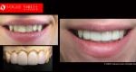 Cosmetic Dentistry Treatment Results Gallery, closeup photos porcelain veneers before and after Melbourne, Affordable Dental Veneers Before and After Melbourne close-up, Vogue Smiles Dental Dentistry Melbourne Studios Clinic Practice