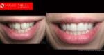 Cosmetic Dentistry Treatment Results Gallery closeup photos - Vogue Smiles Dental Dentistry Melbourne Studios Clinic Practice