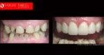 Cosmetic Dentistry Treatment Results Gallery closeup photos - Vogue Smiles Dental Dentistry Melbourne Studios Clinic Practice