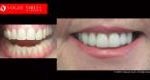 Cosmetic Dentistry Treatment Results Gallery closeup photos - Vogue Smiles Dental Dentistry Melbourne Studios Clinic Practice