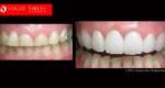 Cosmetic Dentistry Treatment Results Gallery closeup photos - Vogue Smiles Dental Dentistry Melbourne Studios Clinic Practice