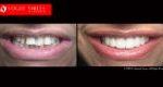 Cosmetic Dentistry Treatment Results Gallery closeup photos - Vogue Smiles Dental Dentistry Melbourne Studios Clinic Practice